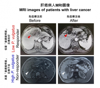 港大醫學院科研團隊將腸道細菌「普通擬桿菌」移植至肝癌小鼠模型，結果發現原本對免疫治療敏感的小鼠，在移植後出現耐藥現象。這項發現與肝癌患者的臨床觀察結果相符。圖中MRI顯示，「普通擬桿菌」含量較低的肝癌患者對免疫治療反應較佳。
 